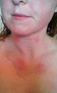British woman severe  super high flux led allergic skin on the water