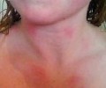 British woman severe  super high flux led allergic skin on the water