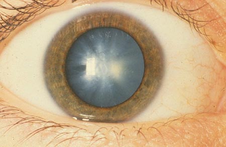 British studies have found that LED technology can diagnose early cataracts