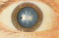 British studies have found that LED technology can diagnose early cataracts
